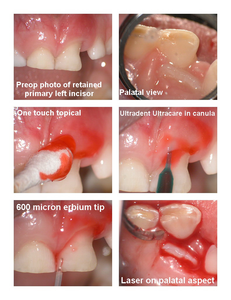 Pediatric Extration pg 1.jpg